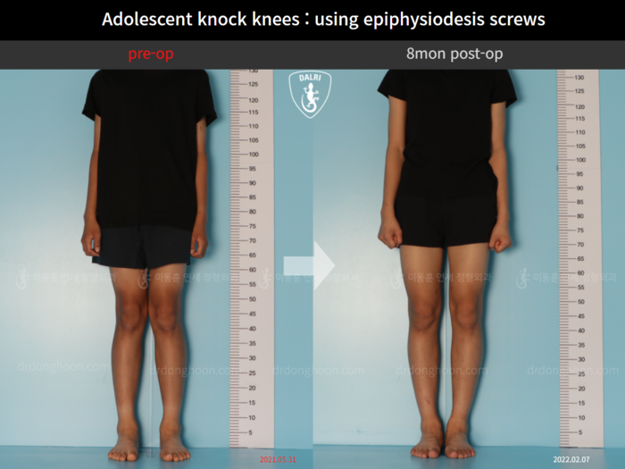 Paediatric & adolescent knock knees