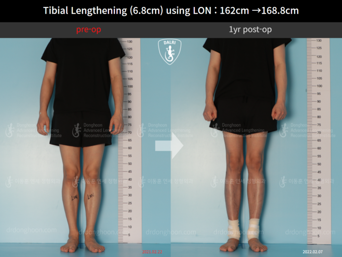 Tibial lengthening, 6.8 cm gained