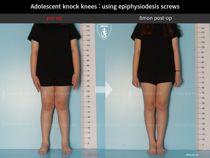 Paediatric & adolescent knock knees