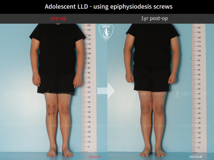 Paediatric & adolescent LLD