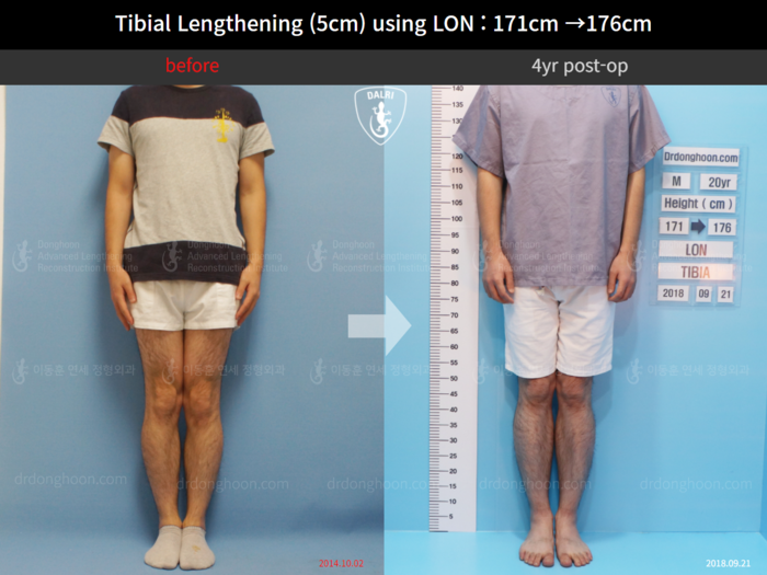 Tibial lengthening, 5 cm gained