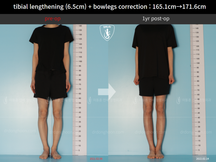 ยืดกระดูกหน้าแข้ง เพิ่มขึ้น 6.5 ซม.