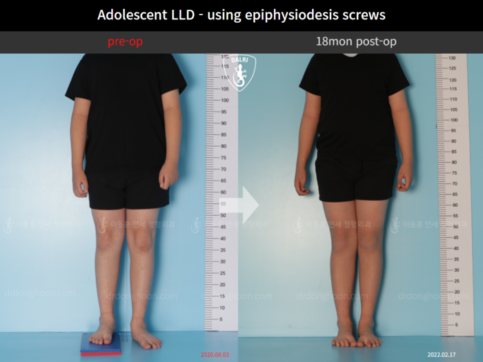Paediatric & adolescent LLD