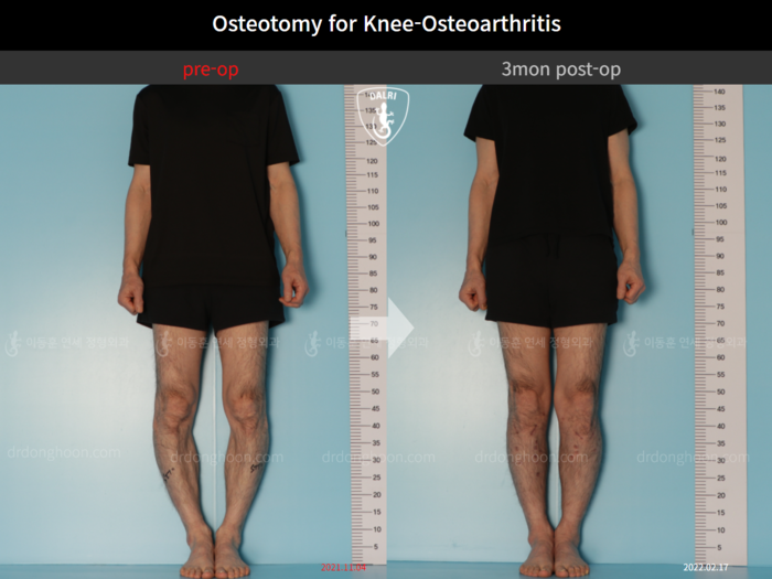 Osteotomy for knee osteoarthritis