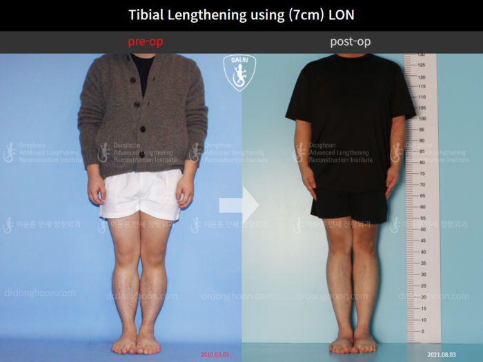 Tibial lengthening, 7 cm gained