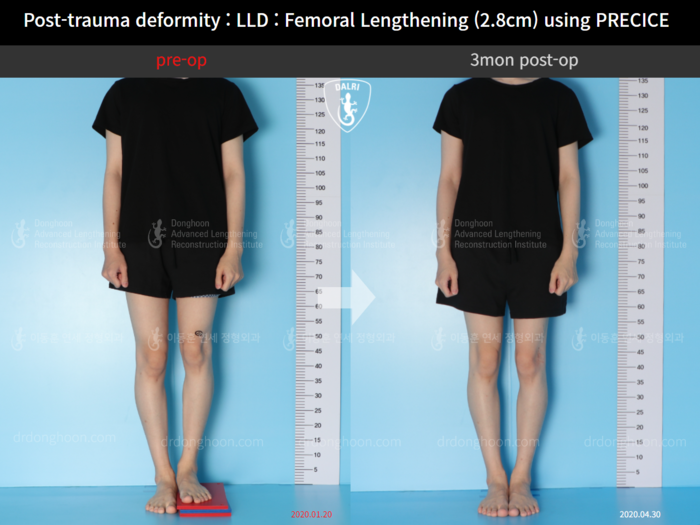 ยืดกระดูกต้นขา เพิ่มขึ้น 2.8 ซม.