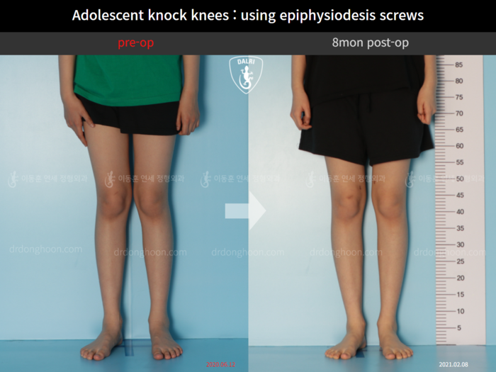 Paediatric & adolescent knock knees