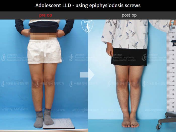 Paediatric & adolescent LLD