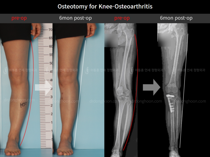 Osteotomy for knee osteoarthritis