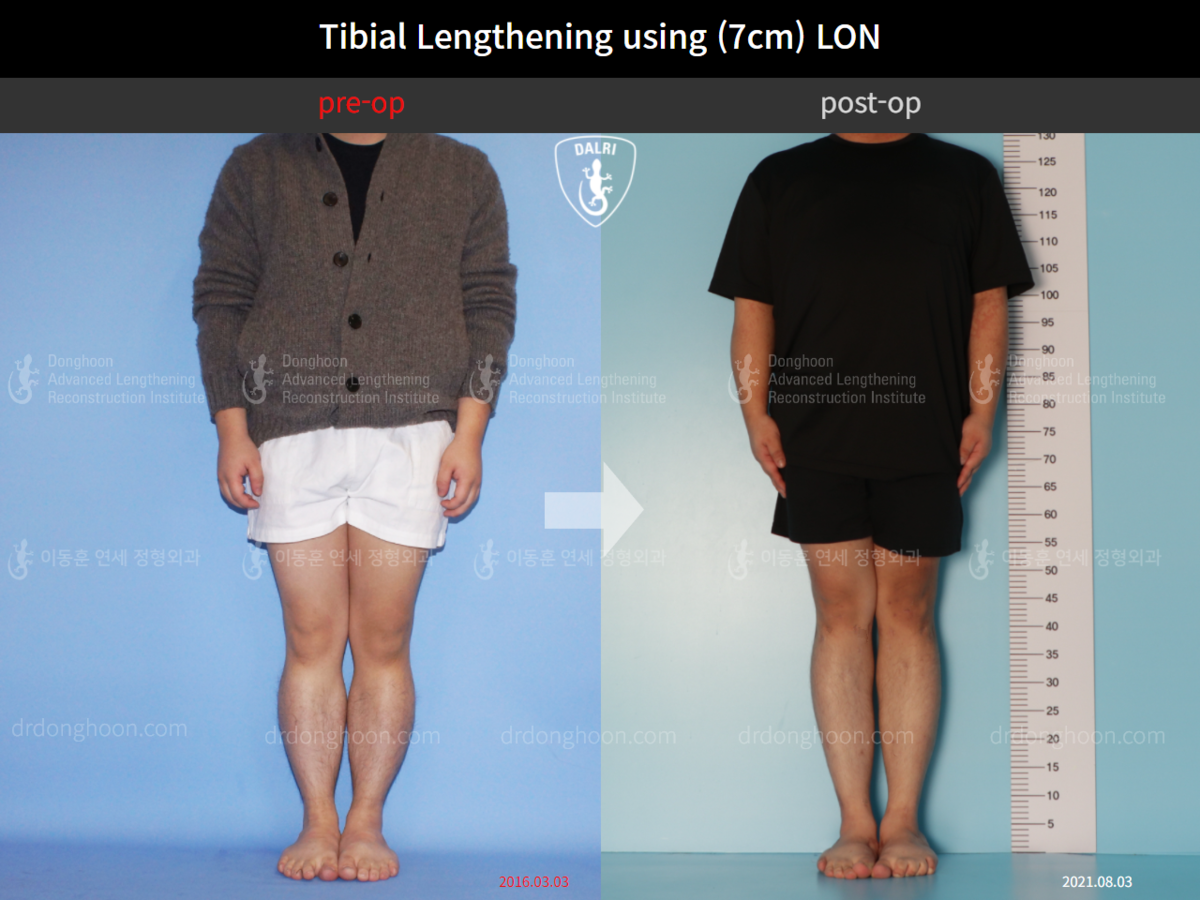 Tibial Lengthening Using (7cm) LON : DALRI Before & After