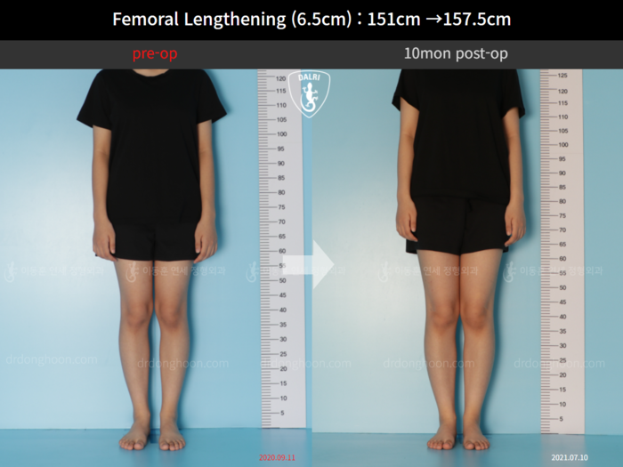 ยืดกระดูกต้นขา เพิ่มขึ้น 6.5 ซม.