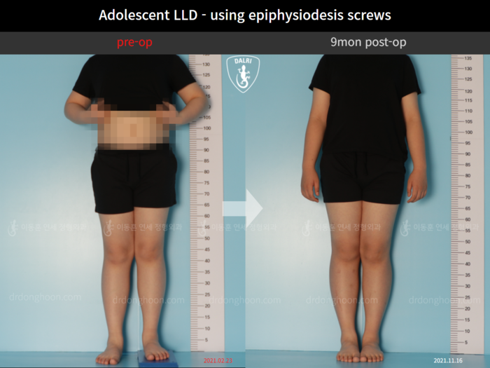 Paediatric & adolescent LLD