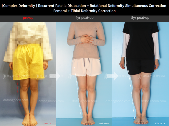 Femoral + tibial lengthening