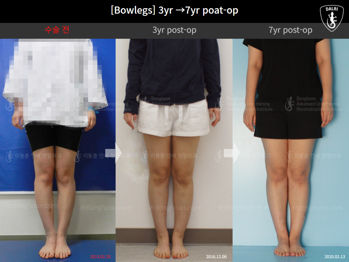 [Bowlegs] 3yr →7yr postop Adult Bowlegs