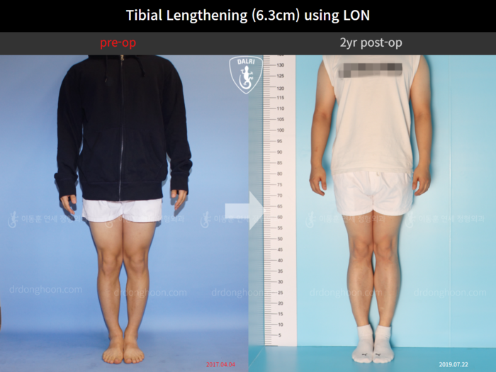 Tibial lengthening, 6.3 cm gained