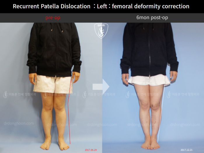 Femoral lengthening