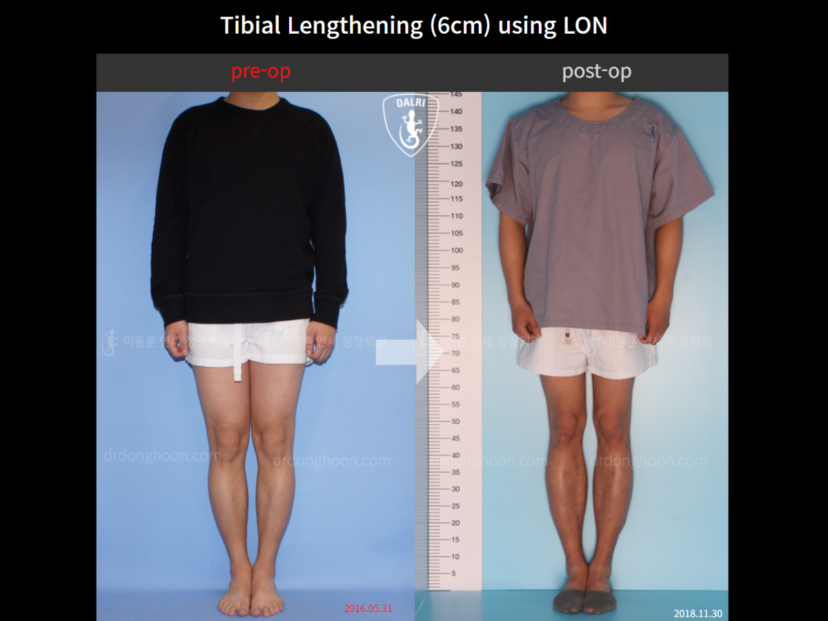 Tibial Lengthening (6cm) Using LON : DALRI Before & After