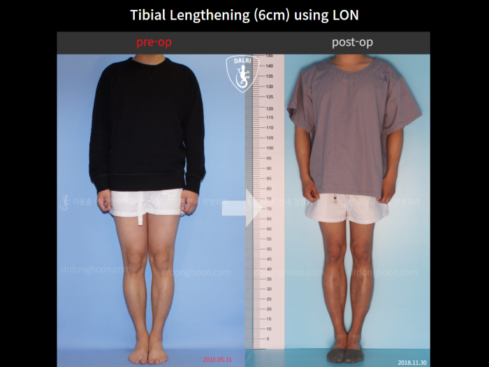 Tibial lengthening, 6 cm gained