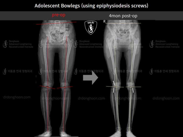 Paediatric & adolescent bowlegs