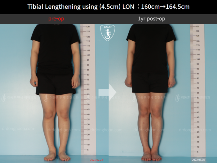Tibial lengthening, 4.5 cm gained