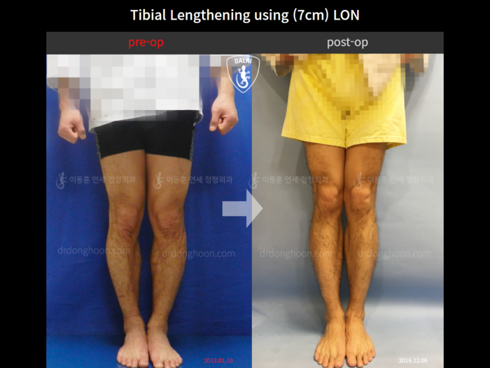 Tibial lengthening, 7 cm gained