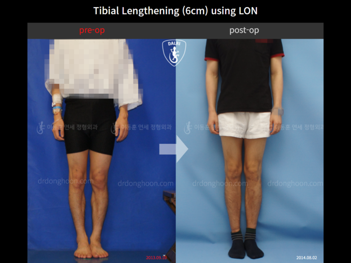 Tibial lengthening, 6 cm gained
