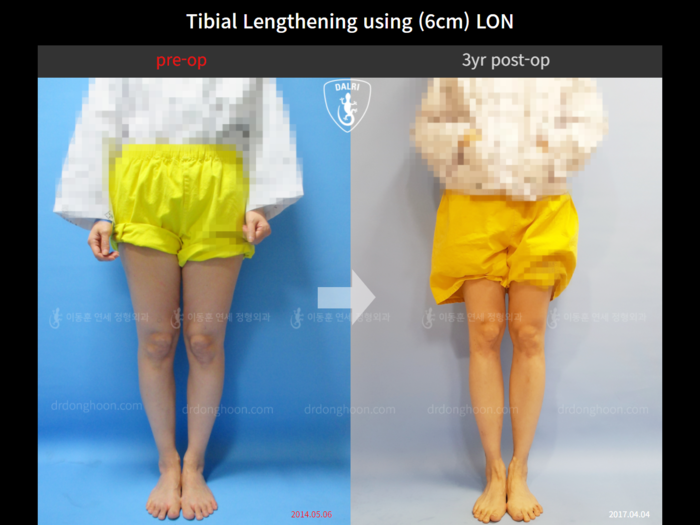 Tibial lengthening