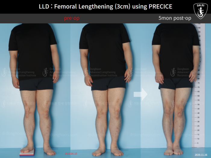 Femoral lengthening, 3 cm gained