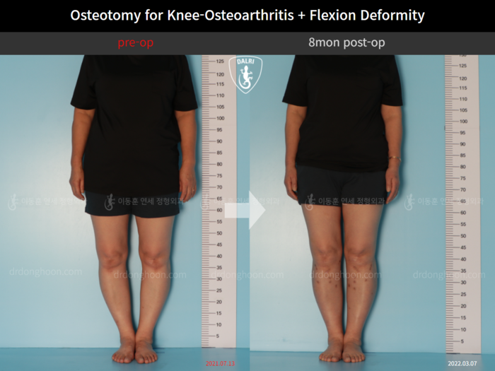 Osteotomy for knee osteoarthritis