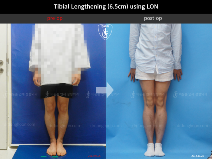 Tibial lengthening, 6.5 cm gained
