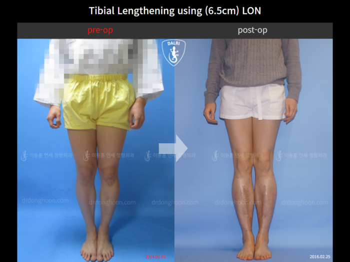 Tibial lengthening, 6.5 cm gained