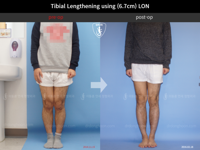 Tibial lengthening, 6.7 cm gained
