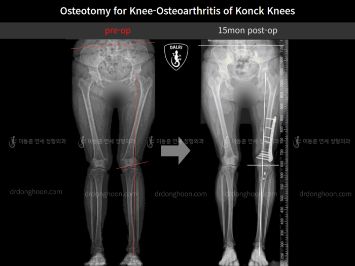 Osteotomy for knee osteoarthritis