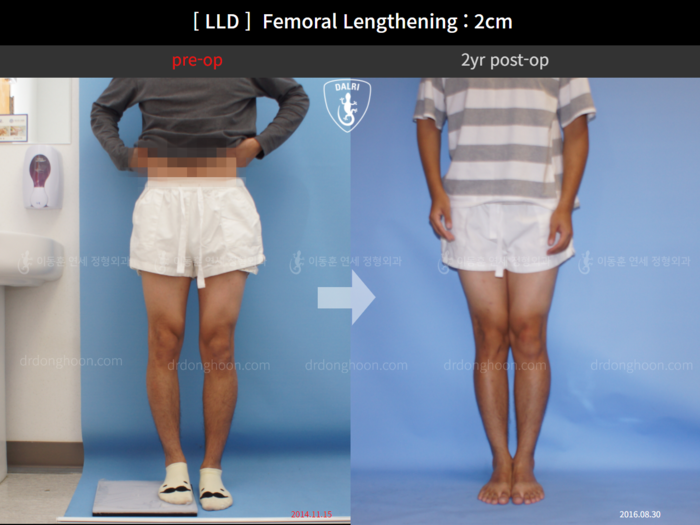 Femoral lengthening