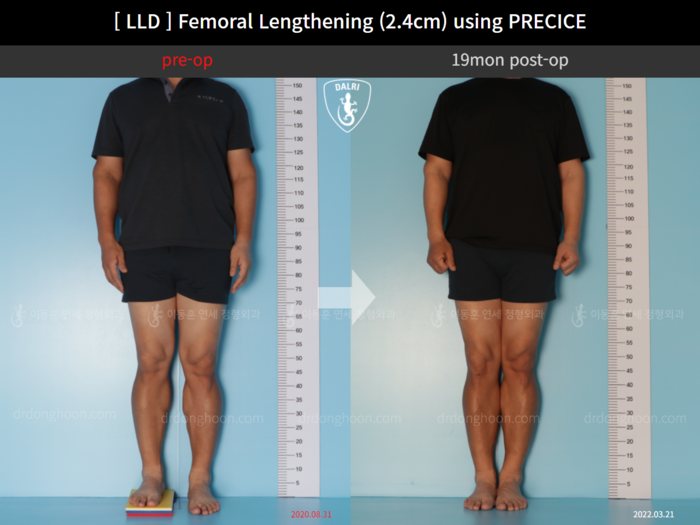 ยืดกระดูกต้นขา เพิ่มขึ้น 2.4 ซม.