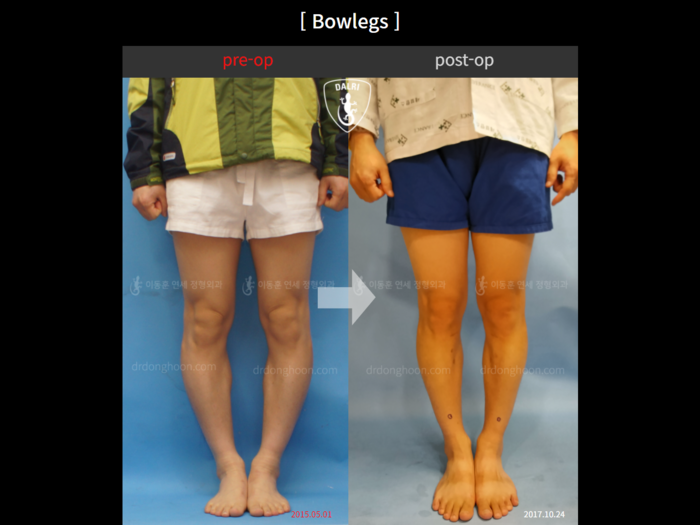 Adult bowlegs