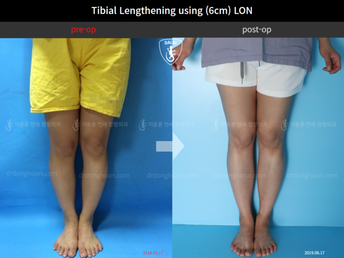 CLL LON, 6 cm gained