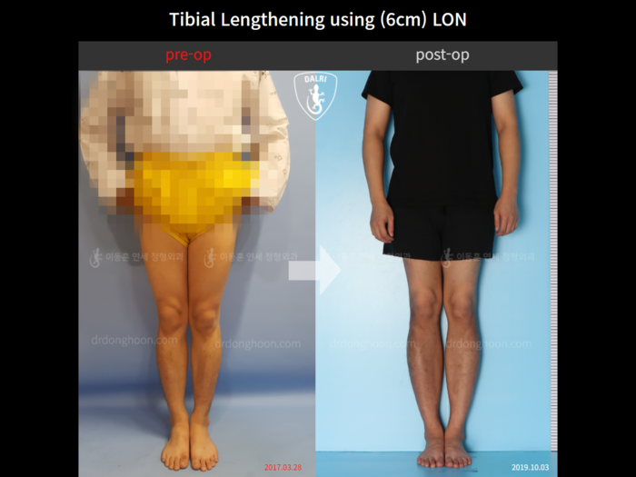Tibial lengthening, 6 cm gained