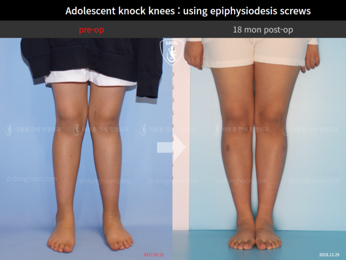 Bowlegs, knock knees & knee osteoarthritis before and after radiograph example 2