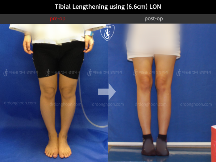 Tibial lengthening, 6.6 cm gained