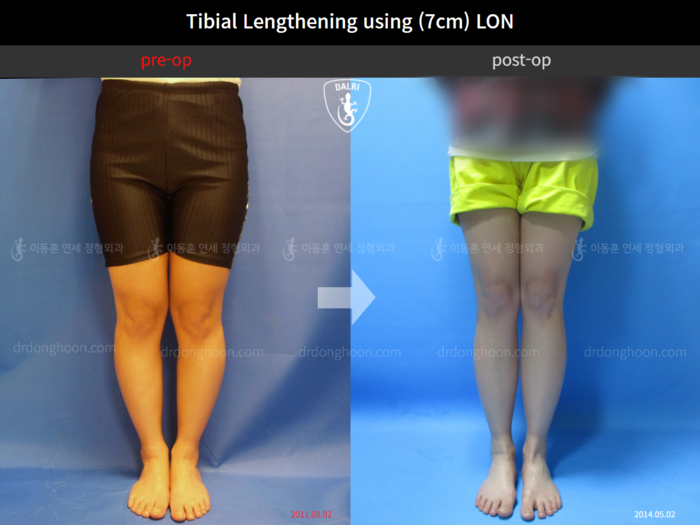 Tibial lengthening, 7 cm gained