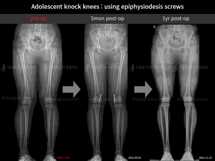 Paediatric & adolescent knock knees