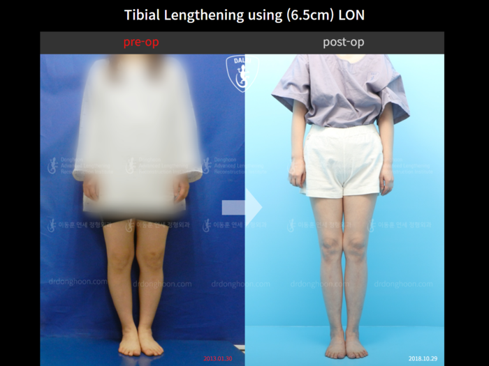 Tibial lengthening, 6.5 cm gained