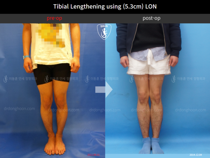 Tibial lengthening, 5.3 cm gained
