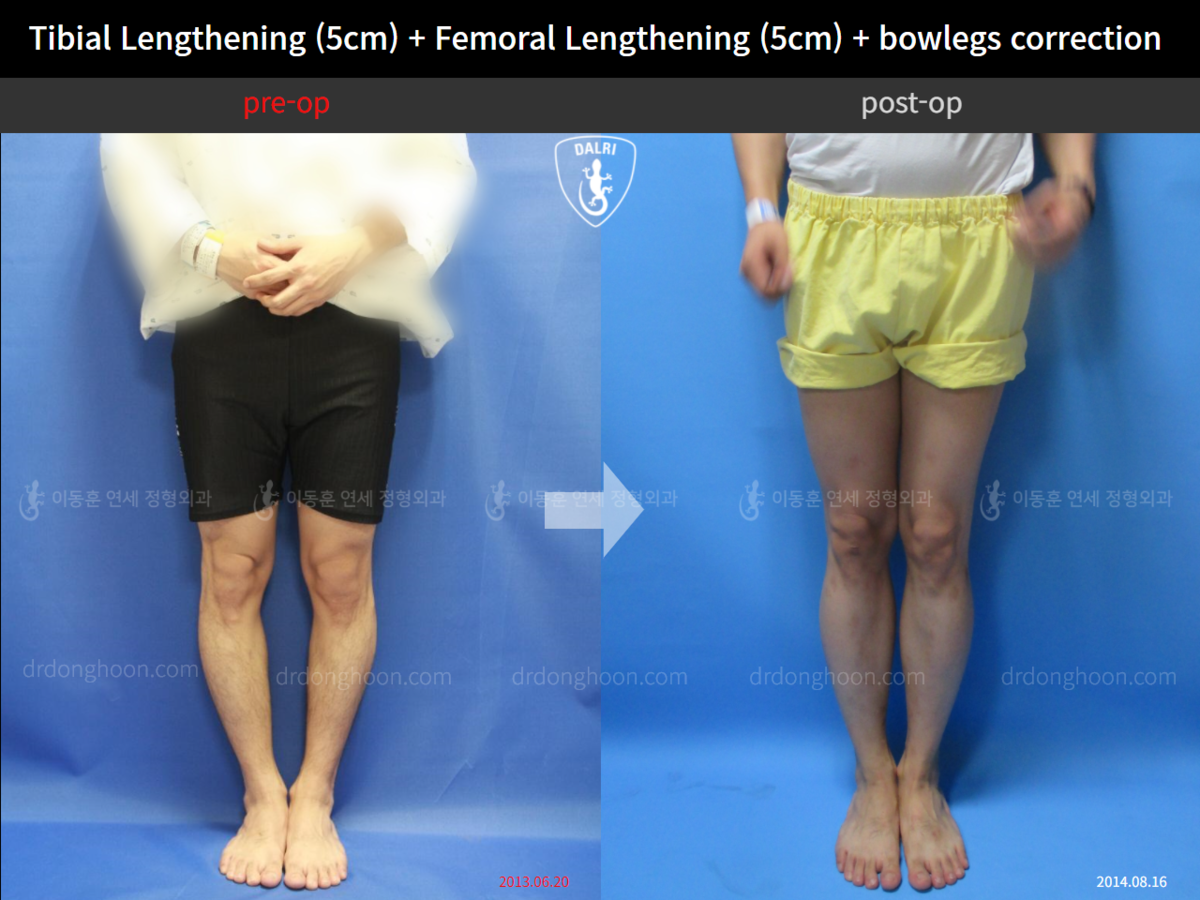 Tibial Lengthening (5cm) + Femoral Lengthening (5cm) + bowlegs ...