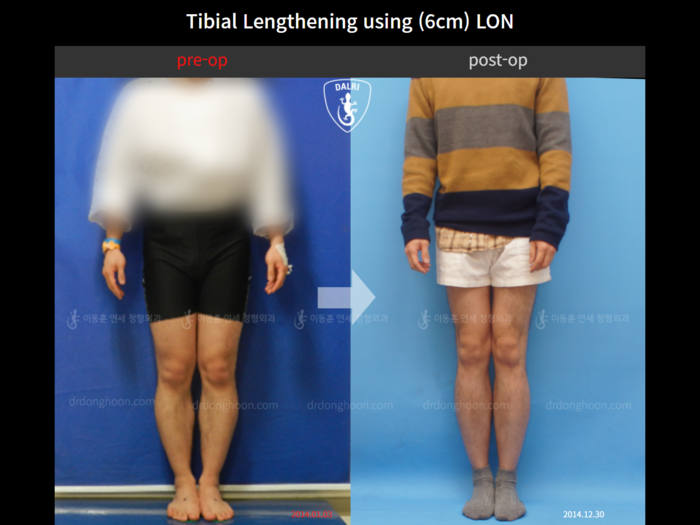 Tibial lengthening, 6 cm gained