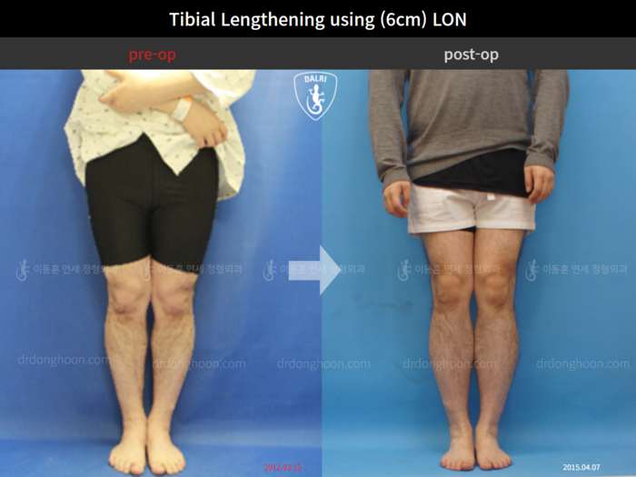 Tibial lengthening, 6 cm gained