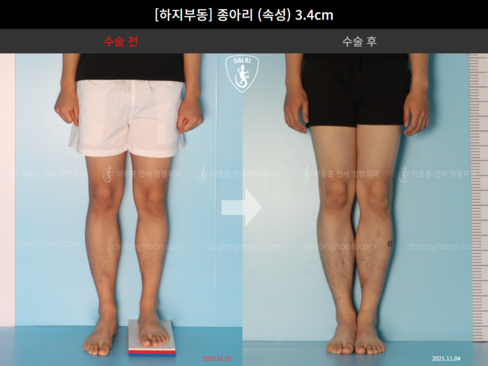Tibial lengthening, 3.4 cm gained