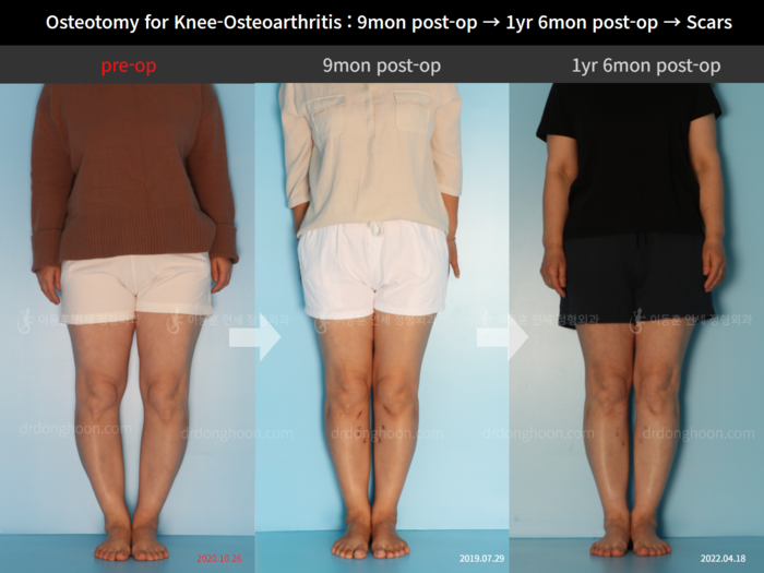 Osteotomy for knee osteoarthritis