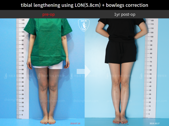 Tibial lengthening, 5.8 cm gained